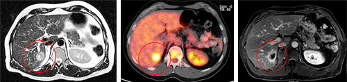 Tumorbild Cyberknife-Bestrahlung